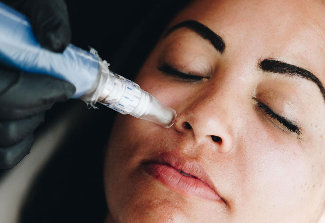 MICRONEEDLING WITH PRP & EXOSOMES